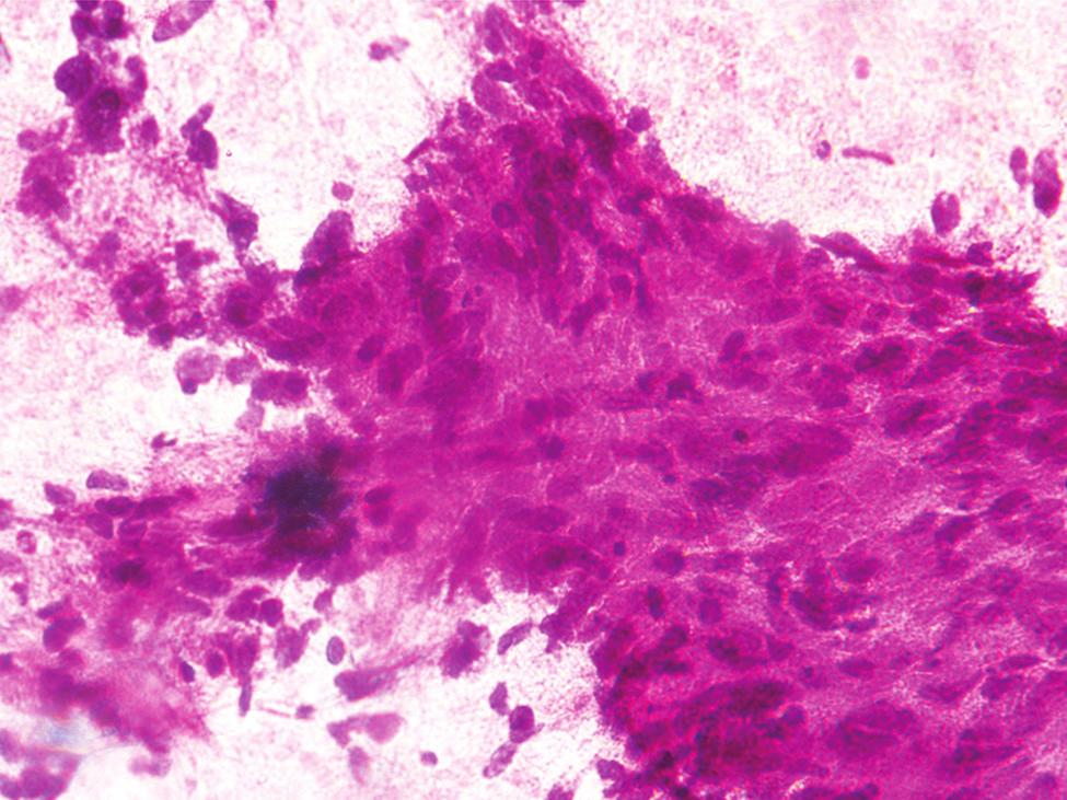 Figures 1-8 depict morphological features of different hepatic lesions seen on cytology. CONCLUSION We found that incidence of malignant hepatic lesions was more than benign.