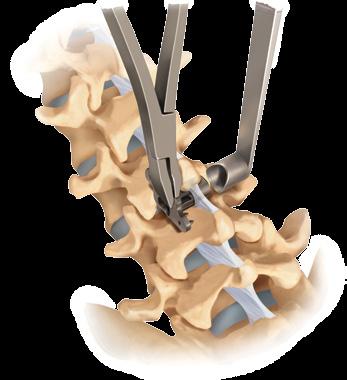 Rotate the implant into its final position while simultaneously removing the sleeve from the interspinous space (Figure 16).