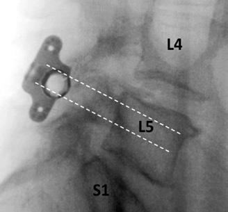 Note: Anterior placement reduces stress on the spinous processes and allows fixation to the thicker, stronger bone at the spinous process/lamina junction.