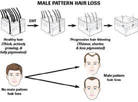 DHT causes a decrease in the growth phase and thinning of the hair (see picture). This leads to male pattern hair loss.