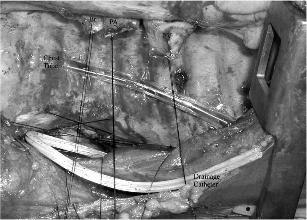 66 R.D. Davis Figure 7 Before performing the donor lung implantation, the postero-lateral closure sutures are placed using two figure-of-eight stitches using a monofilament no. 1 suture.