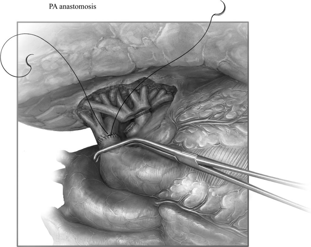 68 R.D. Davis Figure 9 We perform the pulmonary artery (PA) anastomosis next.