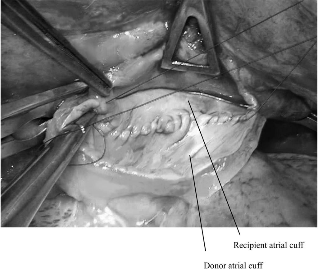 Bilateral sequential lung transplantation 69 Figure 10 The left atrial anastomosis is aided by the previous mobilization of the left atrium by dividing the attachments between the roof of the left