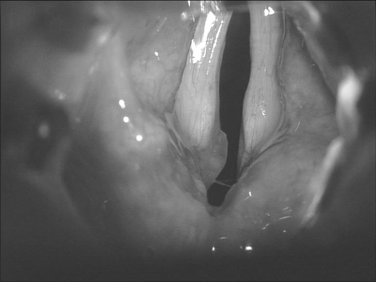 Case Report Bilateral vocal cord palsy caused by syphilis Figure 1: Both vocal cords were in a paramedian position on inspiration and fixed on palpation.