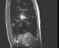 Patient # Motion (mm) 3 2 1 1 MRI cine 3 CT scans LAT