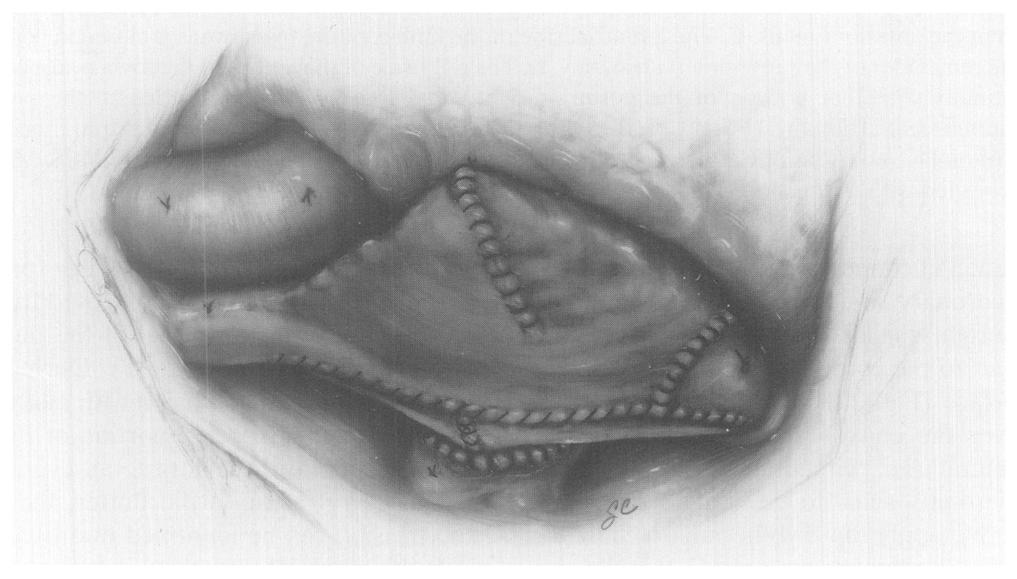 Atlas of Cardiothoracic Surgery. Philadelphia: WB Saunders, 1994:XIV-78. Modified and published with permission.' Fig. 11.
