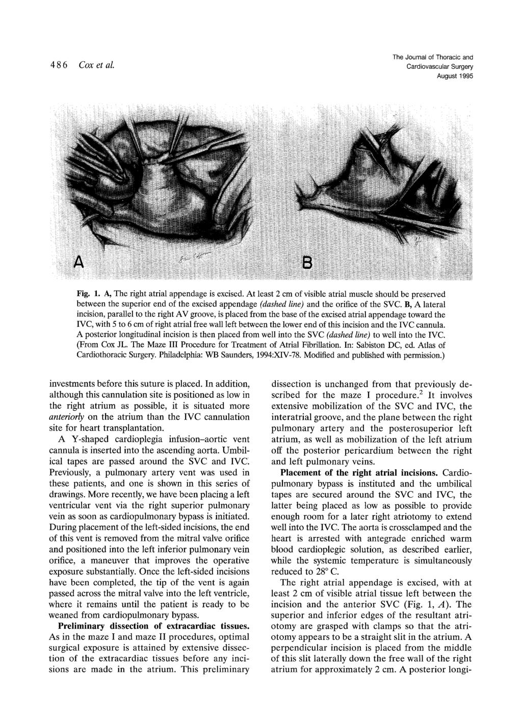 486 Cox et al. August 1995 Fig. 1. A, The right atrial appendage is excised.
