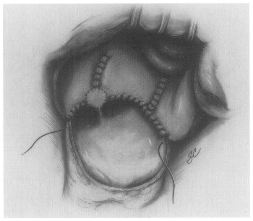posteroinferior left atriotomy to the level of the mitral valve anulus, and partial closure of the superior and inferior portions of the pulmonary vein encircling incision. (From Cox JL.