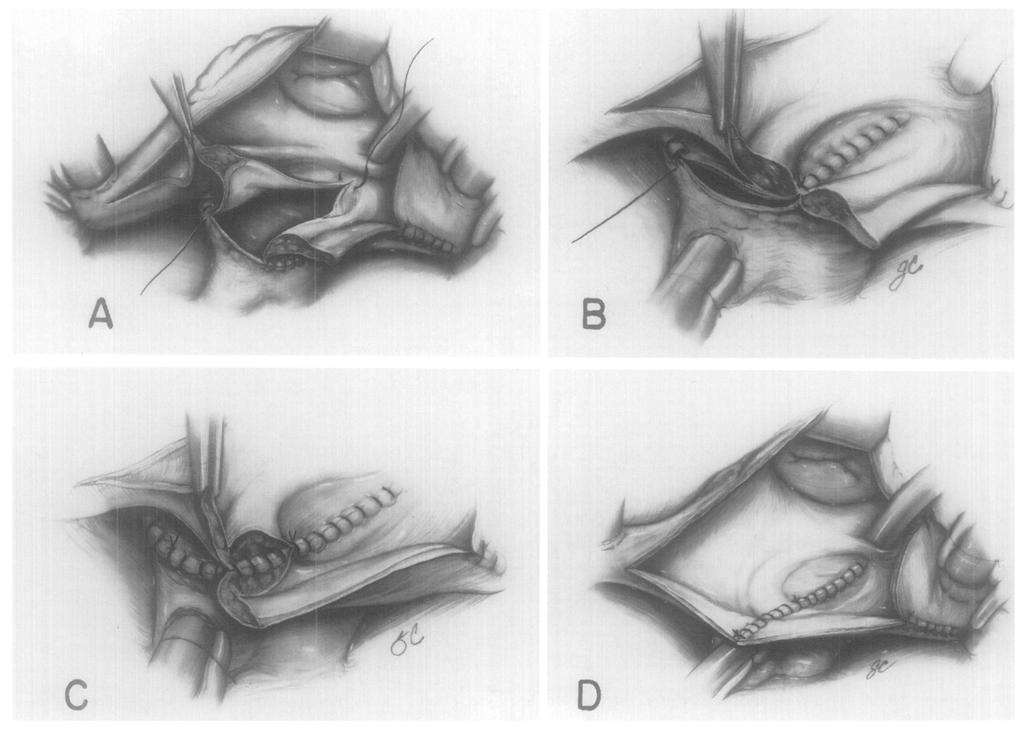 A, Once the lower portion of the pulmonary vein isolation incision has been closed to the level of the atrial septum, the incision again resembles a more standard left atriotomy in the interatrial