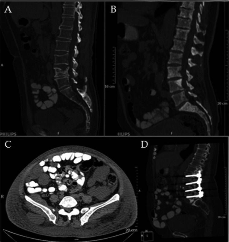 (B) Axial images shows the density measurement technique from trabecular bone (dark ROI), subcutaneous fat planes and the psoas muscle.