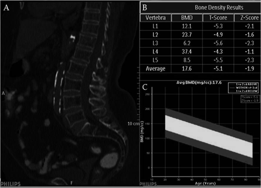 The diagnosis of osteoporosis by measuring lumbar vertebrae density... 777 arately for males and females.