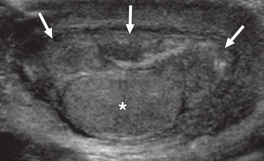 , Gray-scale ultrasound image shows well-defined oval-shaped mass (asterisk) next to epididymis (arrow) and testicle (T),