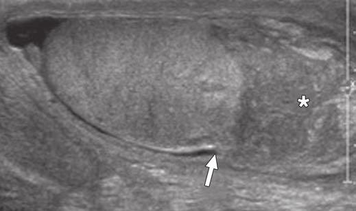 , Color Doppler ultrasound image shows increased vascularity in edematous scrotum (arrows). Note normal vascularity of testes. Fig.