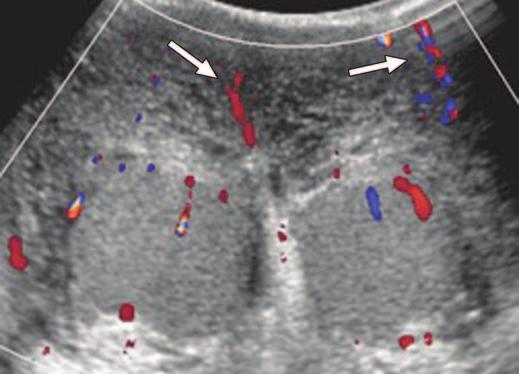 Gray-scale ultrasound image shows interruption of echogenic tunica albuginea (arrow).