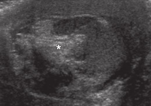 Ultrasound of Pediatric Scrotum Downloaded from www.ajronline.org by 37.44.201.148 on 01/21/18 from IP address 37.44.201.148. Copyright RRS.