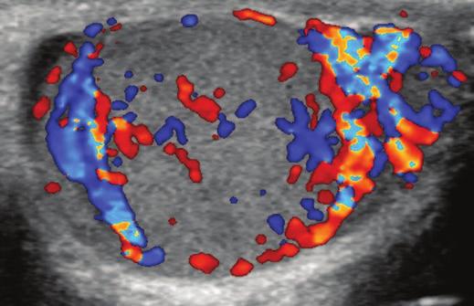 entire testis., Color Doppler ultrasound image shows diffusely increased vascularity around tumor.