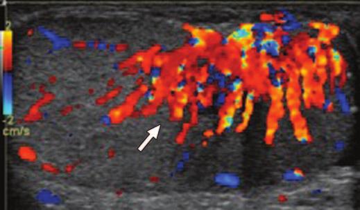 , Gray-scale ultrasound image shows lobular heterogeneous intratesticular mass (arrow).