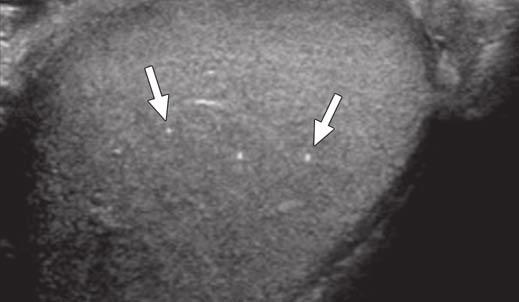 FOR YOUR INFORMTION Fig. 14 13-year-old boy with focal testicular microlithiasis. Gray-scale ultrasound image shows several punctate echogenic foci (arrows), consistent with microliths.