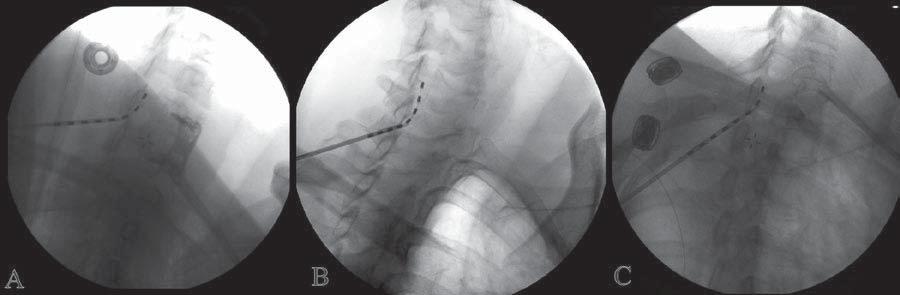 This technique relies on the denseness of the ligamentum flavum and the sudden absence of resistance experienced during ballottement of a syringe filled with saline (with or without an air bubble) or