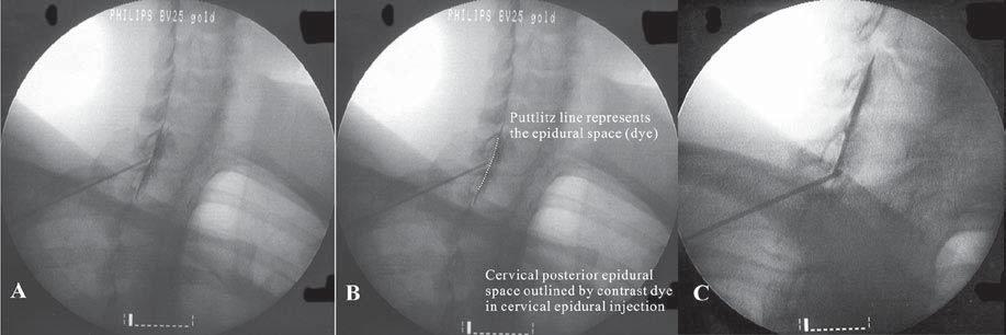 Pain Physician: March/April 2011; 14:195-210 Fig. 4. The cervical posterior epidural space is outlined by contrast dye in the cervical epidural injection with an oblique view (A, C).