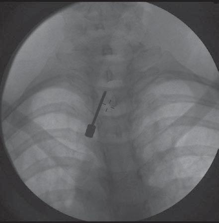 The optimal oblique view is obtained to ensure that the needle is advanced toward the target
