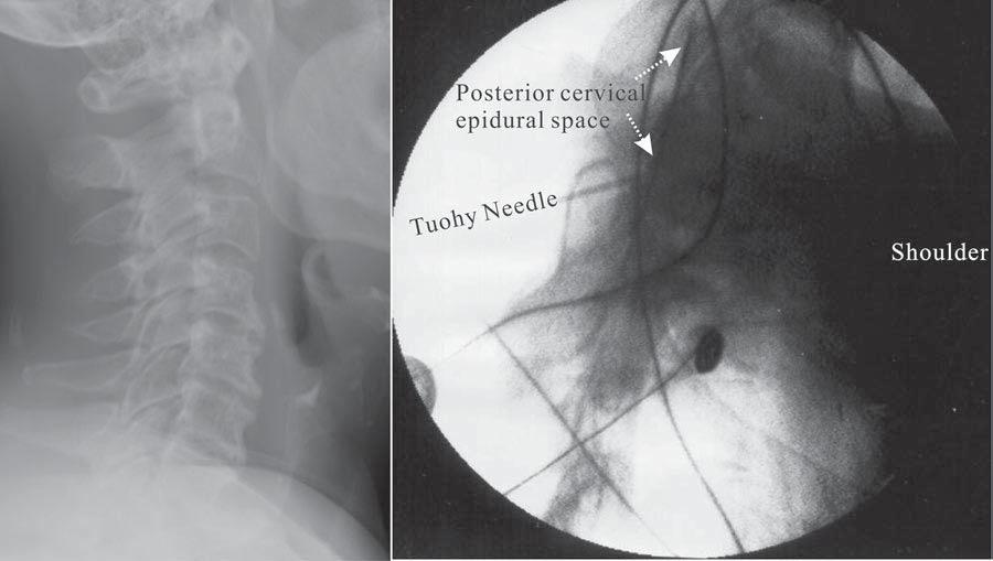 Alternative Approach to Needle Placement in Cervical Spinal Cord Stimulator to monitor epidural access is to visualize needle movement related to bony landmarks.