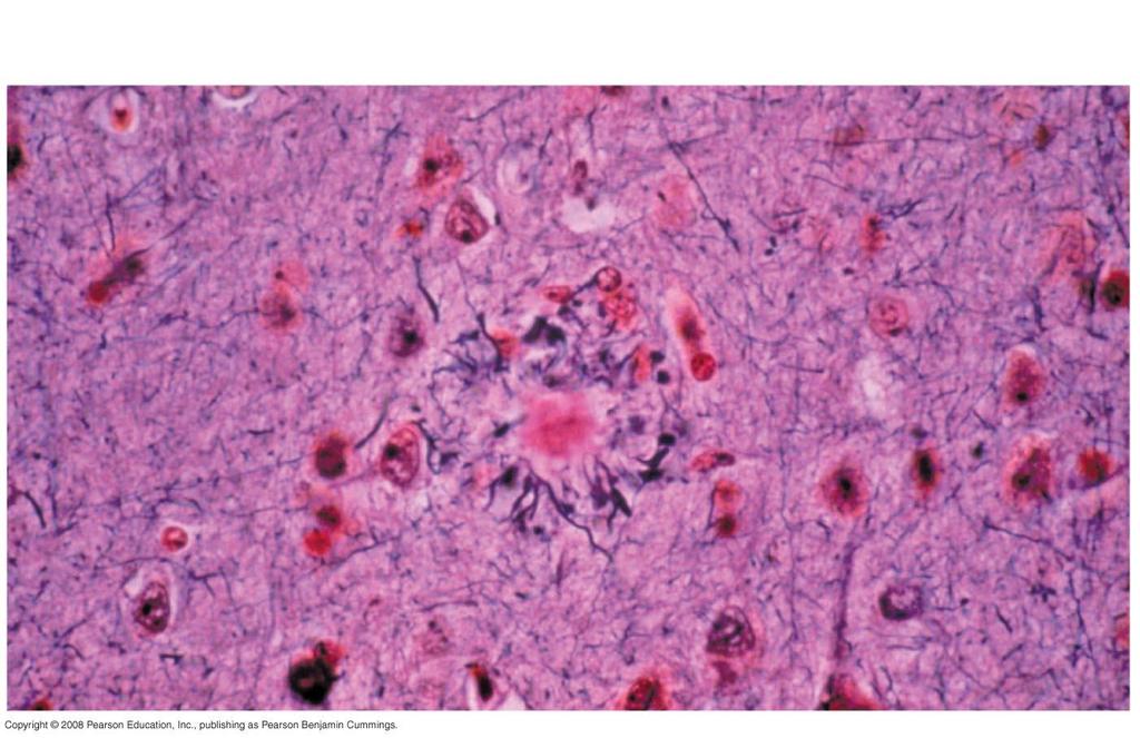 Fig. 49-23 Amyloid plaque
