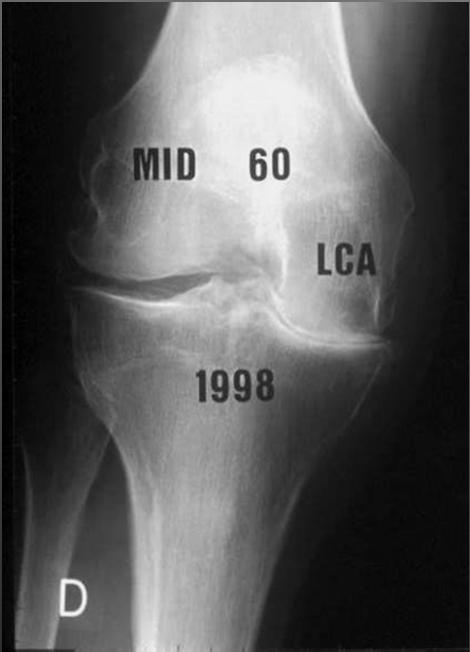 Isolated Meniscectomy Radiological results At radiological evaluation, meniscectomy over an unstable knee