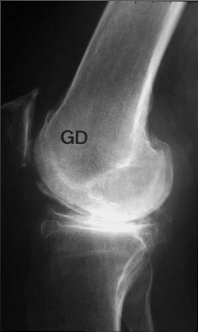 This osteoarthritis has some characteristics such as hooked tibial spines, osteophytes of the intercondylar