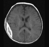 and right lateral ventricle MRI Brain without contrast: Heterogeneously lenticular right parietal extra-axial fluid collection (T1 hyperintense; T2/FLAIR mildly hyperintense), with relative
