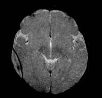 intracranial bleed, fractures, cerebral edema and hypoxic-ischemic injury Attenuation of subdural / epidural hematoma varies by chronicity: Acute - hyperdense Subacute isodense Chronic