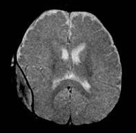 second investigation Best performed 5-10 days after insult Can reliably differentiate between acute and chronic subdural hematoma Most sensitive modality for detecting early ischemic