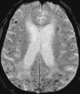 Sensitivity of GRE imaging for hemosiderin in an 80-year-old man with dementia that has progressed over the past 4 years Do we know more than dementia? Previous CVA symptoms? Risk factors?