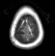 CT Venography with