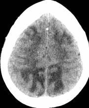 CT Head: Posterior > anterior cerebral hemispheric white matter hypodensity