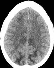 signal within bilateral cerebral hemispheric white mater (parietooccipital >