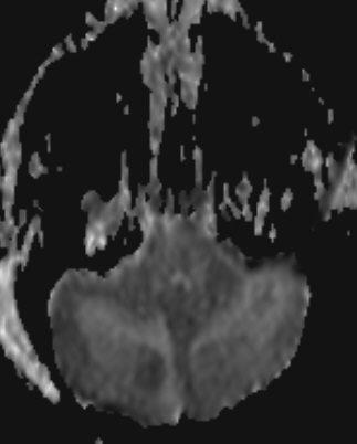 with ensuing interstitial extravasation of fluid Diffusion MR imaging - used