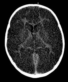 Multiple Sclerosis MRI Brain: Hyperintense FLAIR signal scattered throughout the frontal-parietal