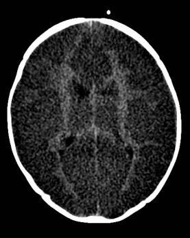 junction on the sagittal FLAIR sequence Inflammatory demyelinating condition of the central