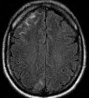 Indicative of diffuse cerebral edema and early transtentorial herniation Diffuse hypoxic-ischemic cerebral injury Major cause of