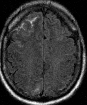 MRI Brain: Hyperintense FLAIR signal within scattered cerebral sulci Unremarkable on other sequences Patent basilar cisterns Subarachnoid hemorrhage Differential diagnosis of hyperintense FLAIR