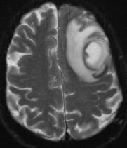 Cerebral abscess MRI Brain: Left frontal lobe intra-axial lesion with