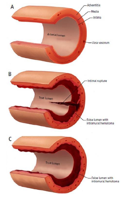 Spontaneous Coronary Artery Dissection Prevalence and Epidemiology >