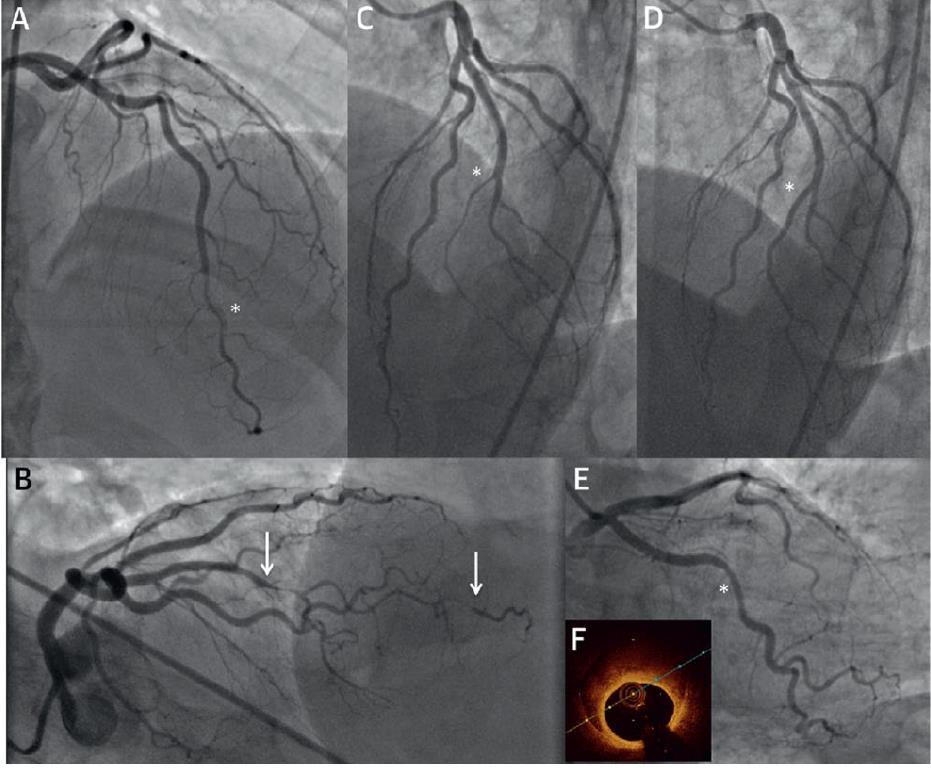 Spontaneous Coronary Artery Dissection Management Coronary angiography