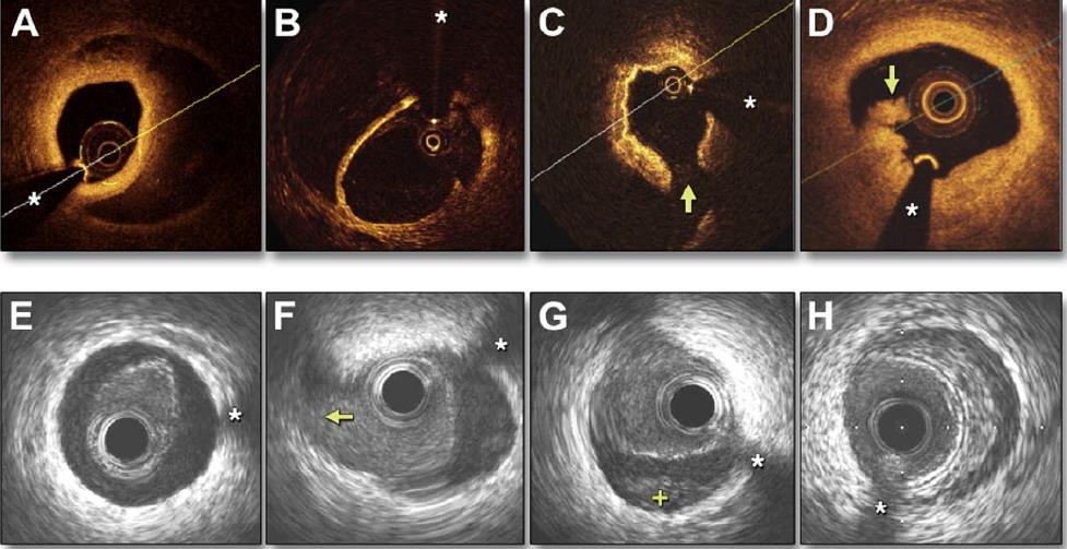 revascularization PCI associated with low success rates and increased need