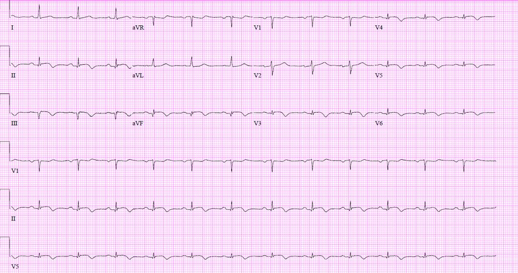 71 Echo: LVEF 48%; Extensive LAD territory wall motion abnormalities
