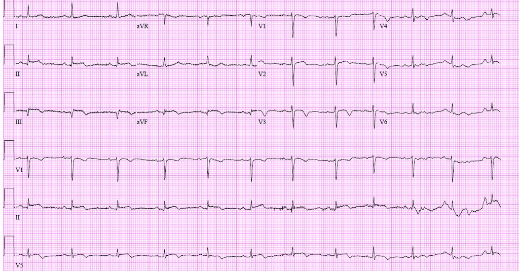Case Presentation F/U: Represented 72 hours later with Sudden onset of chest