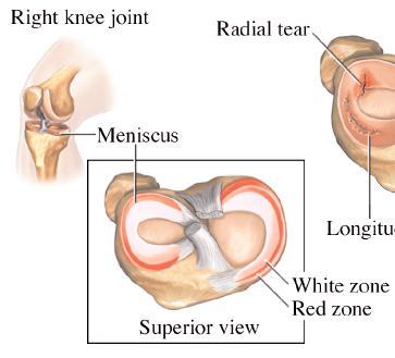 What is a Meniscus? There are two menisci in the knee which sit between the thigh bone (femur) and shin bone (tibia).