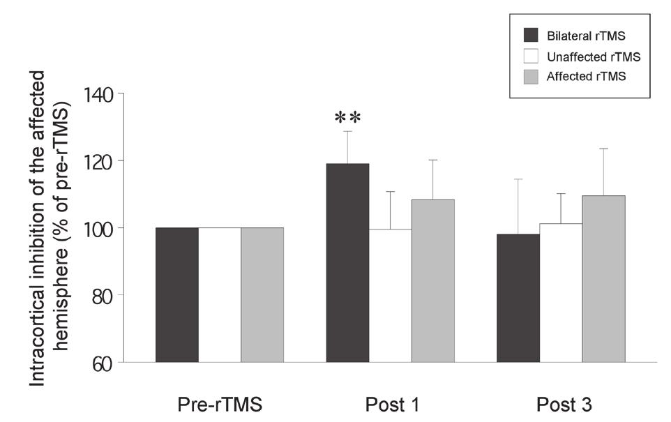 Bilateral rtms and motor training 1053 Fig. 4. The change in the intracortical inhibition after repetitive transcranial magnetic stimulation (rtms).