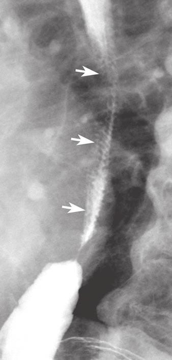 were seen only as barium refluxed from stomach. Large hiatal hernia also is present. of reflux, 10 had marked GER (50%), seven had moderate GER (35%), and three had mild GER (15%).